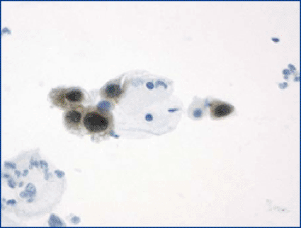 Image: Cells from cervical intraepithelial neoplasia. Cytoplasmic and nuclear positivity for p16INK4a in dysplastic cells (photo courtesy mtm laboratories). 